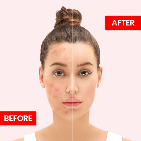 Hydrating Beauty Cream |Removes Scars, Spots, Pimples & Acne