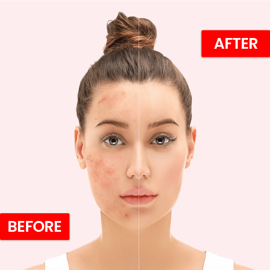 Hydrating Beauty Cream |Removes Scars, Spots, Pimples & Acne